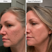 PDRN Micro Infusione skin booster