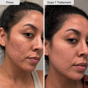 PDRN Micro Infusione skin booster