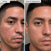 PDRN Micro Infusione skin booster