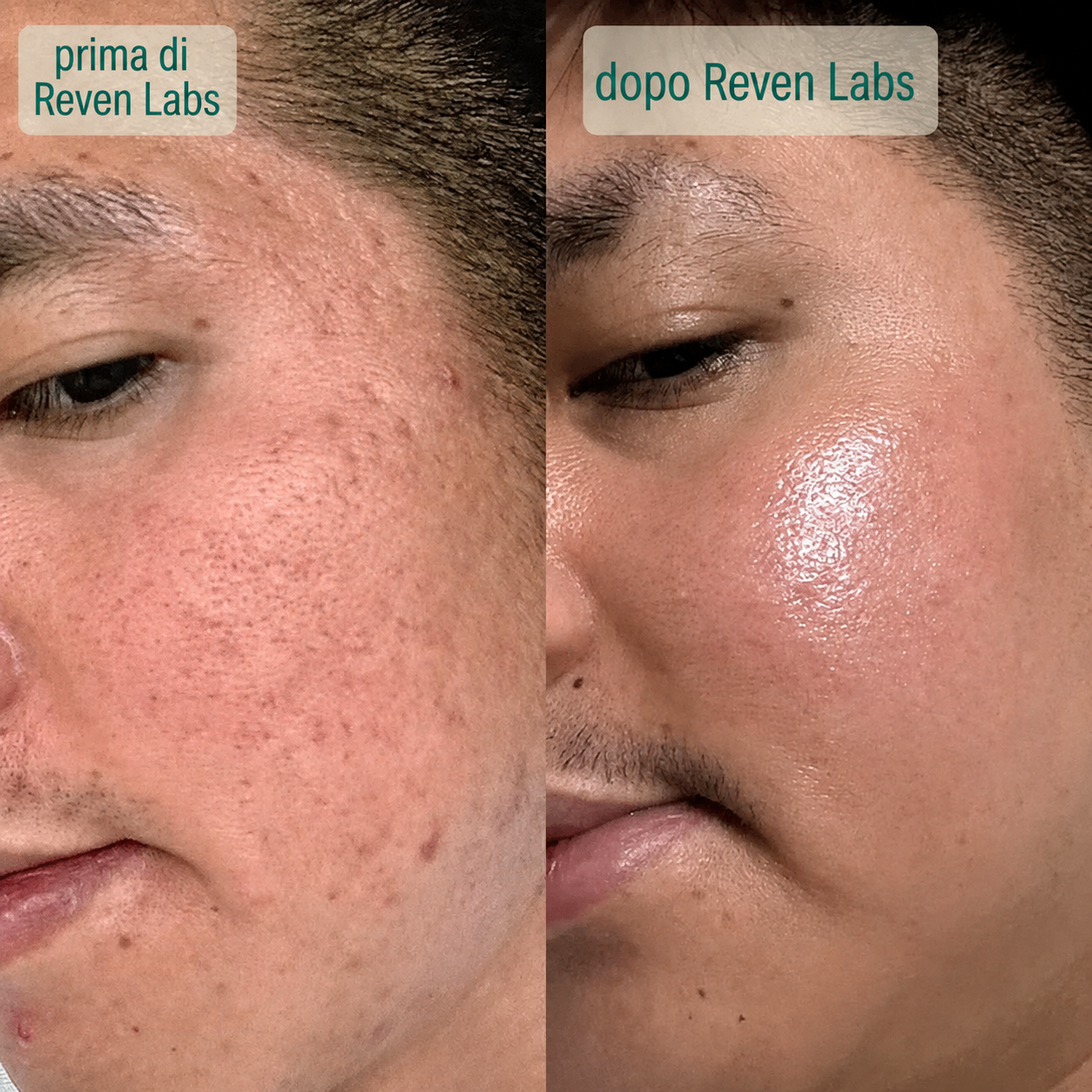Siero acne