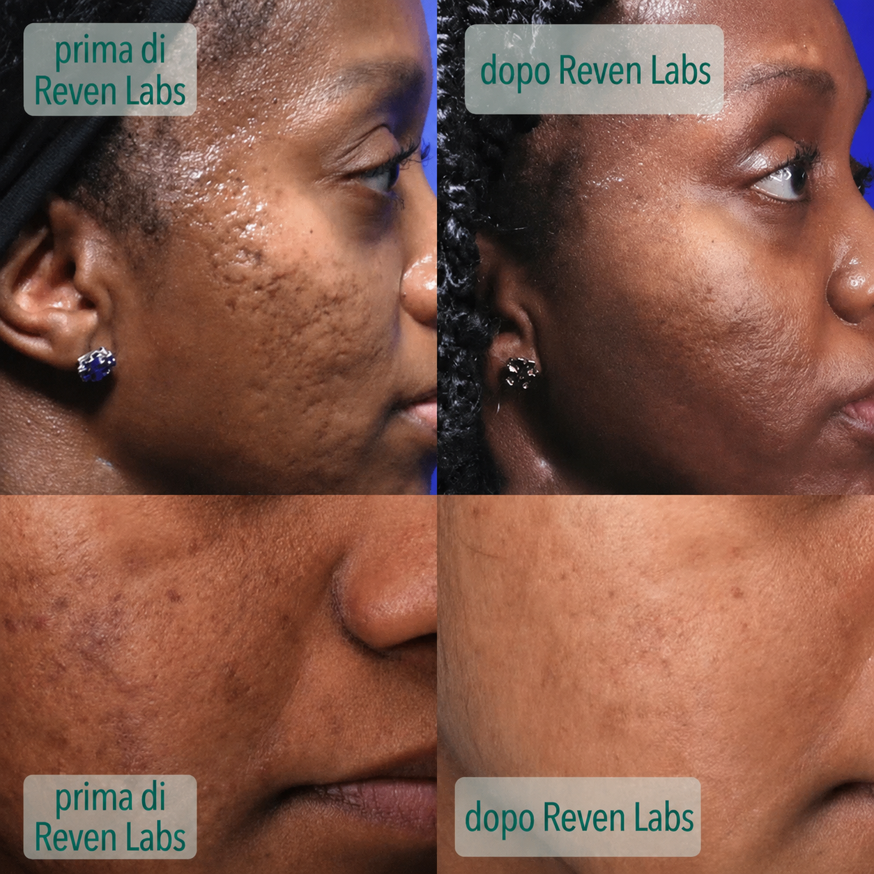 Siero acne