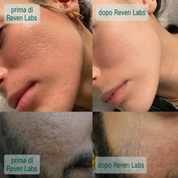 Siero acne