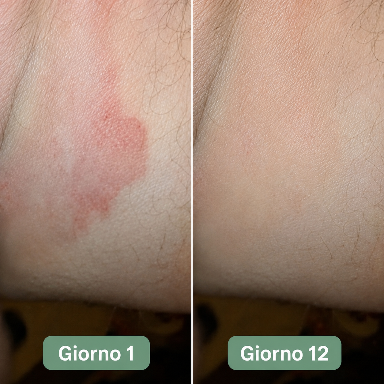 Sapone antifungino inguinale