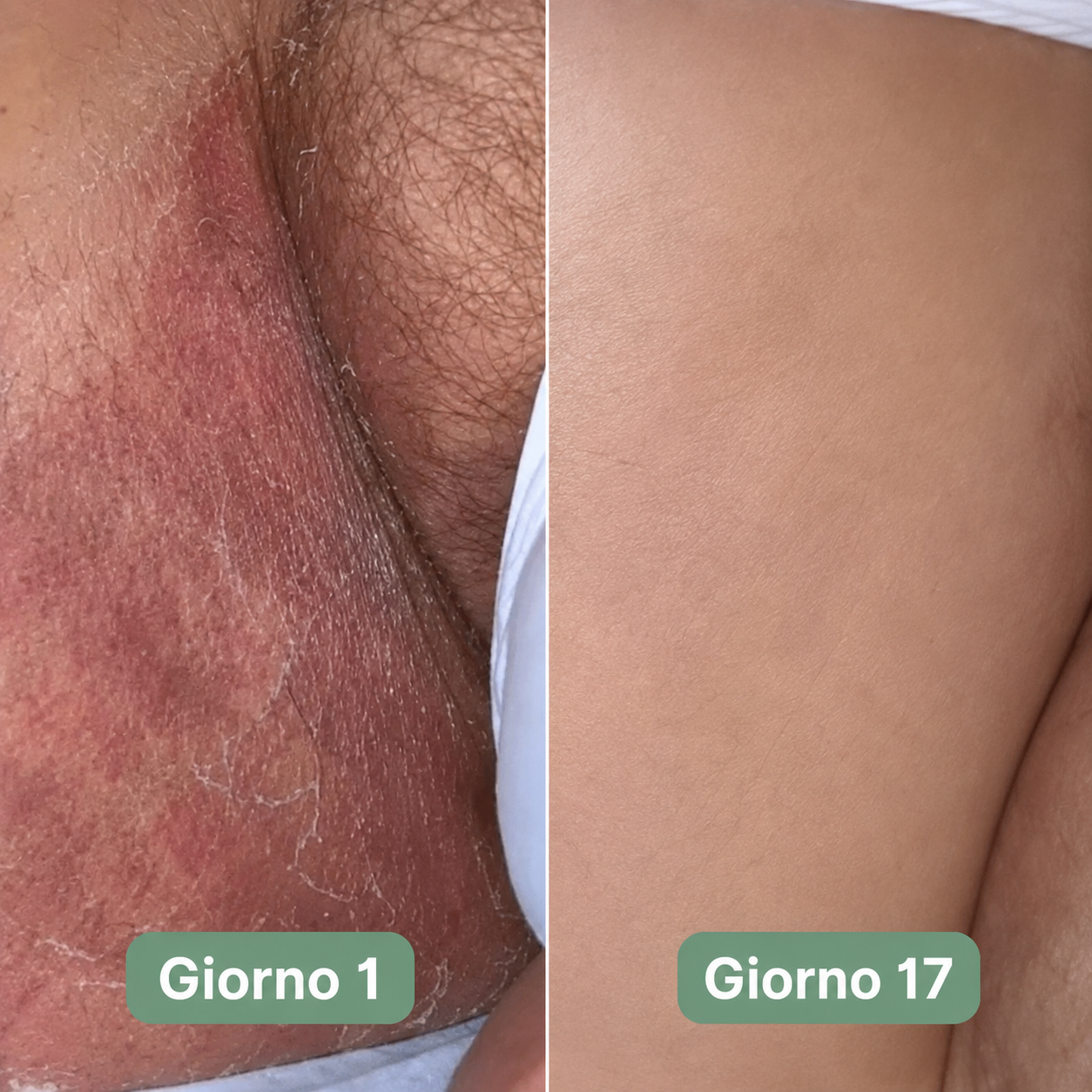 Sapone antifungino inguinale