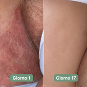 Sapone antifungino inguinale