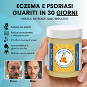Balsamo riparatore per eczema e psoriasi